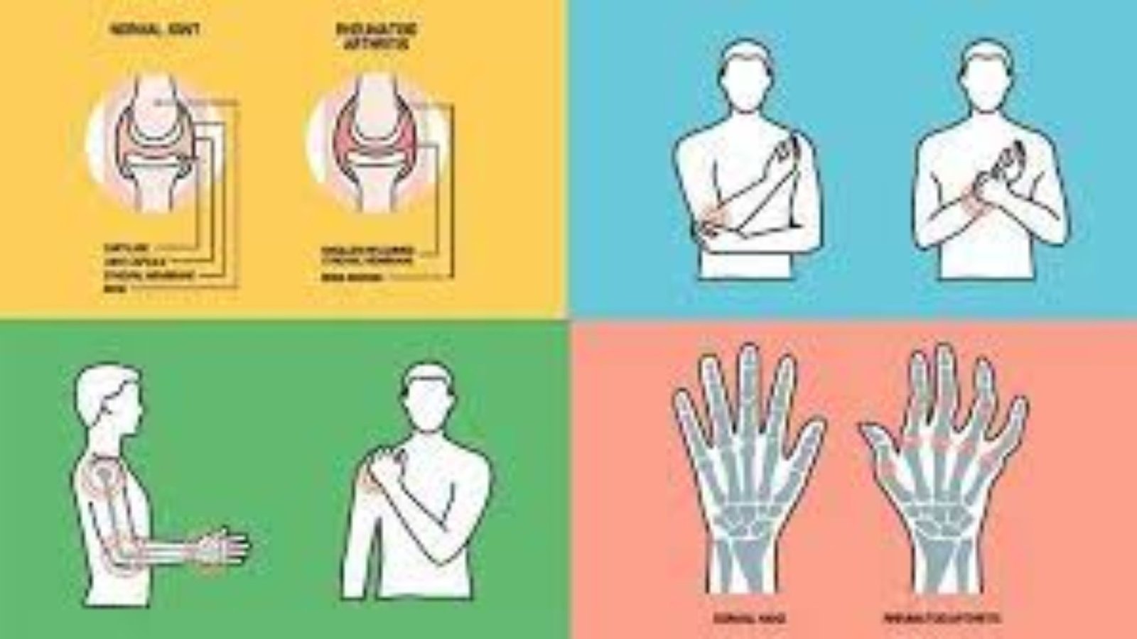 <a></a>Rheumatoid Arthritis: What Causes It And How To Avoid It <a></a>Rheumatoid Arthritis: What Causes It And How To Avoid It