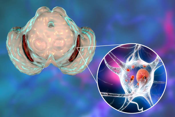 What is The PSP Form of Frontotemporal Dementia What is The PSP Form of Frontotemporal Dementia