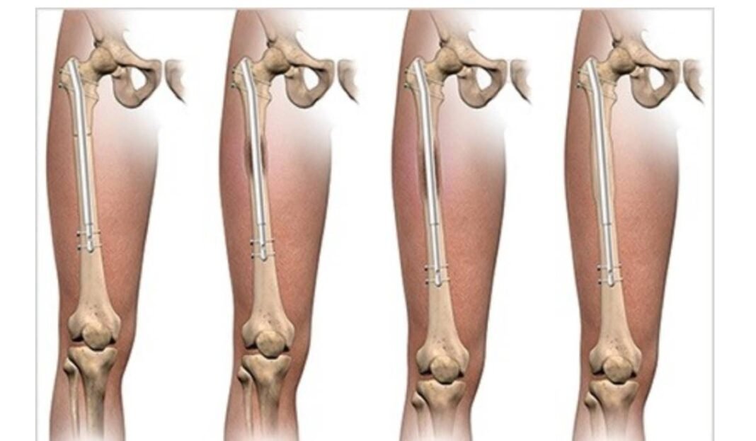 The Evolution Of Limb Lengthening: How Precision Max Leads The Way? Limb Lengthening