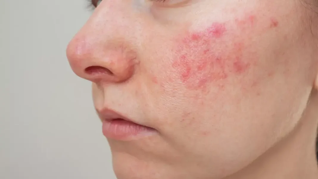 Red Face Treatment: How To Calm And Soothe Irritated Skin? Red Face
